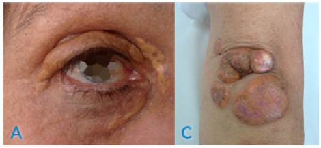 Paciente 2. A) Arco corneal y xantelasmas; B) xantomas en codo.