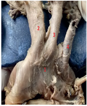 Aortic arch Type I. 1: AA; 2: BTC; 3: RCCA; 4: LSA.