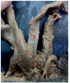 Aortic arch Type II. 1: AA; 2: BA; 3: BCT; 4: LCCA; 5: LSA.