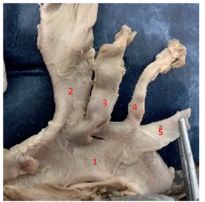 Aortic arch Type III. 1: AA; 2: BCT; 3: LCCA; 4: LVA; 5: LSA.