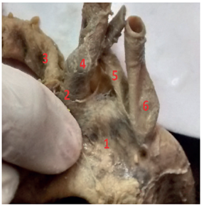 Aortic arch Type V. 1: AA; 2: Common trunk originated from 3: RCCA and 4: LCCA; 5: ARSA; 6: LSA.