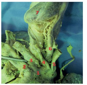 Aortic arch Type VIII. 1: AA; 2: BCT; 3: LCCA; 4: TIA; 5: LSA; 6: esophagus; 7: thyroid gland.