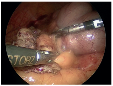 Apendicitis en fase perforada. Visión por laparoscopia.