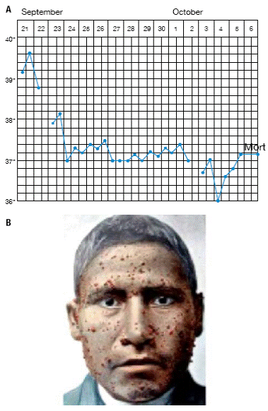 Unicist theory of Carrion's disease. A) Febrile curve by Daniel Alcides Carrión, who suffered from Oroya fever; B) Patient with Peruvian wart. Source: 3.