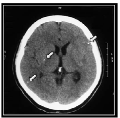 Computerized axial tomography scan which allows observing calcifications that suggest the effects of neuro-cysticercosis. Source: Own elaboration based on the data obtained in the study.