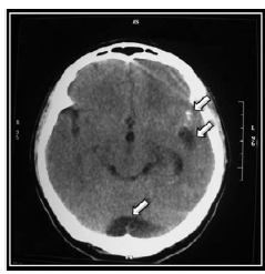 Computerized axial tomography scan which allows observing, from top to bottom, calcifications, cystic image located in the left Sylvian fissure compatible with neurocysticercosis in vesicular phase and megacisterna magna. Source: Own elaboration based on the data obtained in the study.