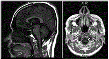 Head magnetic resonance imaging showing a cystic lesion adjacent to the medulla oblongata. Source: Own elaboration based on the data obtained in the study.