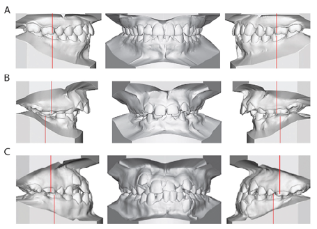Clasificación de la maloclusión según Angle.