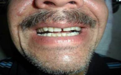 Bruxismo con desgaste anormal de los dientes inferiores.