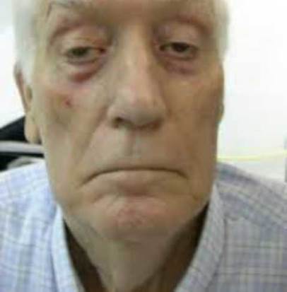 Distrofia muscular oculofaríngea, debilidad facial y bulbar.