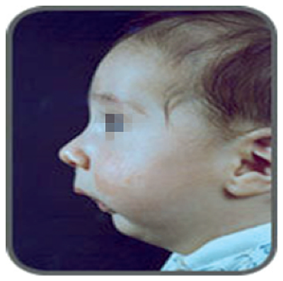 Micrognatia en un niño con síndrome de Pierre Robin.
