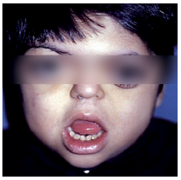Micrognatia en un niño con Enfermedad de Crouzon.