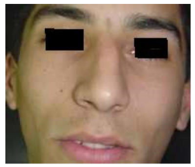Desviación nasal.
