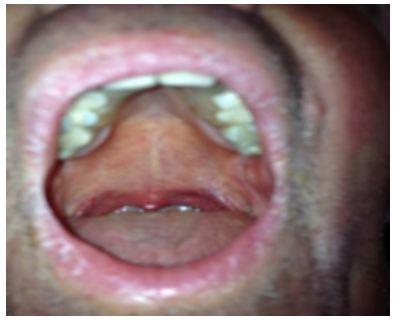 Paladar ojival, dientes apiñados.