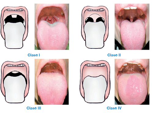 Clasificación de Mallampati modificada.