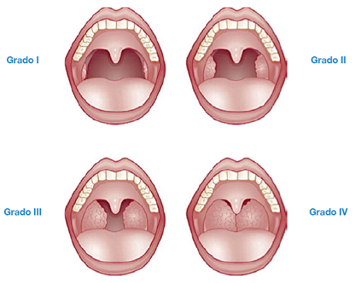 Clasificación del tamaño de las amígdalas.