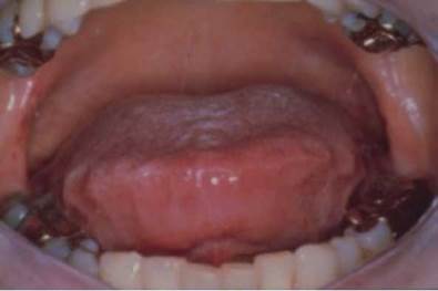 Lengua festoneada en un paciente con síndrome de apnea-hipopnea obstructiva del sueño y amiloidosis.