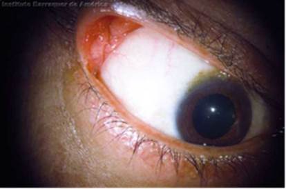 Hiperlaxitud del párpado superior.