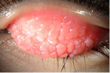 Reacción papilar tarsal.