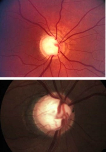 Nervio óptico glaucomatoso.