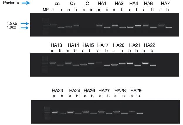 Detecci&oacute;n de la INV1 en la poblaci&oacute;n de estudio. CS: control sano; C+: control positivo; C-: control de reactivos; MP: peso molecular (con el marcador de peso molecular 1Kb Plus. DNA Ladder Invitrogen). Casos positivos para INV1: HA 4, 15 y 20. 