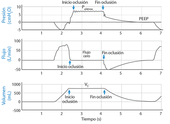 Curvas de presión, flujo y volumen medidos por el ventilador Hamilton C1 durante una prueba de ventilación espontánea con el simulador ASL5000 en una maniobra de oclusión.