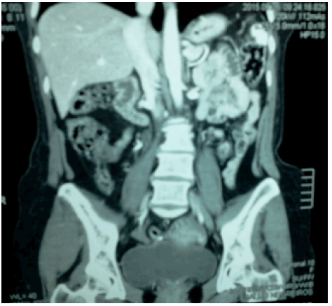 Tomografia axial computarizada de abdomen con contraste.