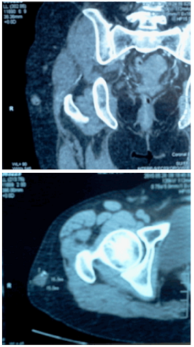 Tomografía axial computarizada de muslo derecho con contraste.
