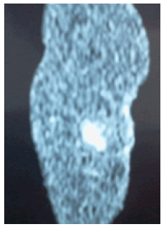 Tomografía axial computarizada de muslo izquierdo con contraste.