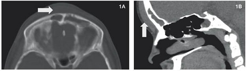 1A y 1B: Tomografia de cr&aacute;neo corte axial y sagital. Se observa material con densidad de tejidos blandos en seno frontal, con engrosamiento de los tejidos blandos (flechas) y sin erosi&oacute;n de la tabla &oacute;sea. 