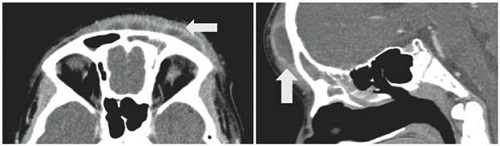 Tomograf&iacute;a de SPN en cortes axial y reconstrucci&oacute;n sagital, donde se aprecia material con densidad de tejidos blandos en seno frontal, relacionado con colecci&oacute;n liquida prefrontal con realce perif&eacute;rico (flechas).
