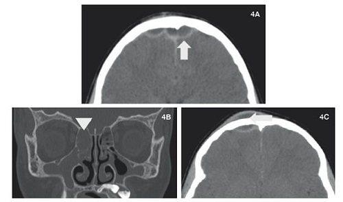 Escanograf&iacute;a de senos paranasales en cortes axiales y reconstrucci&oacute;n coronal, donde se aprecia colecci&oacute;n de tipo epidural frontal (4A, flecha), vinculado con material con densidad de tejidos blandos etmoidomaxilar bilateral (4B, punta de flecha) y colecci&oacute;n liquida prefrontal (4C, flecha).