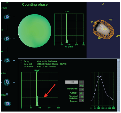 Female patient who underwent a Gated myocardial perfusion SPECT. Histogram representation of phase analysis with narrow bandwidth (arrow) and evidence of left ventricle mechanical synchronism.