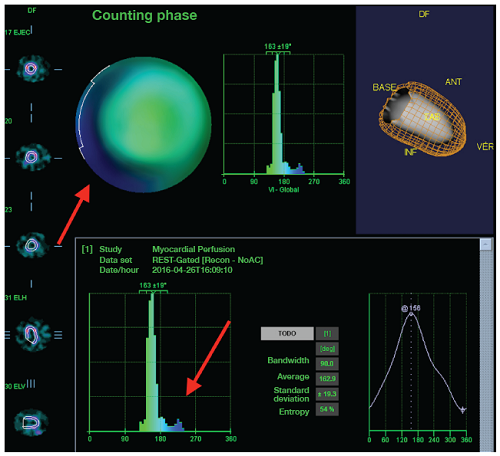 Phase analysis for left ventricular mechanical synchronism assessment by myocardial perfusion SPECT. Phase analysis in which wide bandwidth can be observed over the histogram with evidence of mechanical dyssynchrony of the left ventricle with septal predominance (arrows).