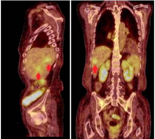 Positron emission tomography with 18fluor-fluor-deoxy-glucose. In the sagittal section (left), the arrows point to two hypermetabolic lesions in segments V and VII of the liver. The coronal section (right) shows the largest lesion in segment VII of the liver.