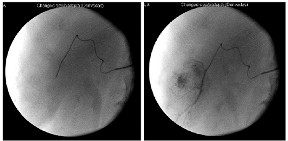 Hepatic arteriogram showing the vascularization of the two lesions before embolization (left) and the dye after embolization (right).