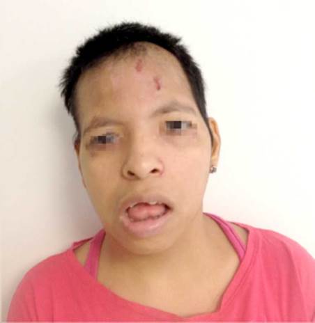 Patient with cri-du-chat syndrome.