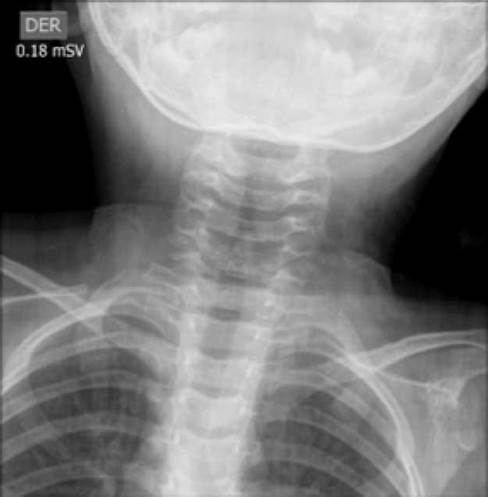 Anteroposterior radiograph of the neck. Steeple sign.