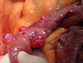 Imagen intraoperatoria que evidencia múltiples neurofibromas en yeyuno medio.