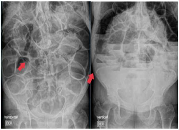 Radiografía de abdomen simple en decúbito supino y bipedestación. - presencia de aire intraluminal y extraluminal como signo de neumoperitoneo.
