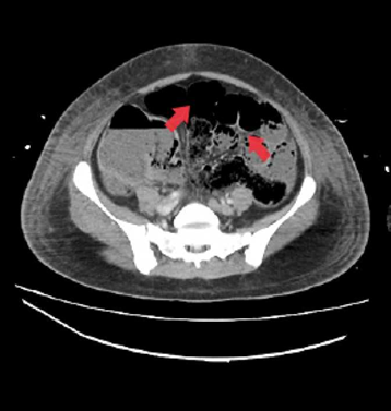 Corte axial de tomografía axial computarizada de abdomen total que evidencia asas intestinales delgadas y gruesas con retardo en el tránsito del contraste asociada a la presencia de neumatosis intestinal y con compromiso de las paredes del íleon distal y ciego.