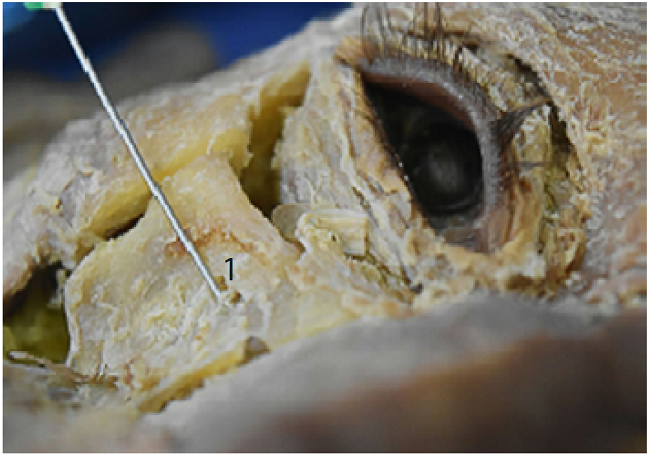 Square cut made in the zygomatic bone. 1: infraorbital nerve passing through the infraorbital foramen after the dissection of the anatomical structures. 