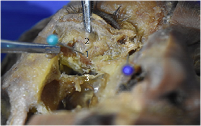 Cutting and resection of the square block of the zygomatic bone with anteroinferior view of the orbital cavity. 1: inferior rectus muscle; 2: inferior oblique muscle; 3: infraorbital nerve. 