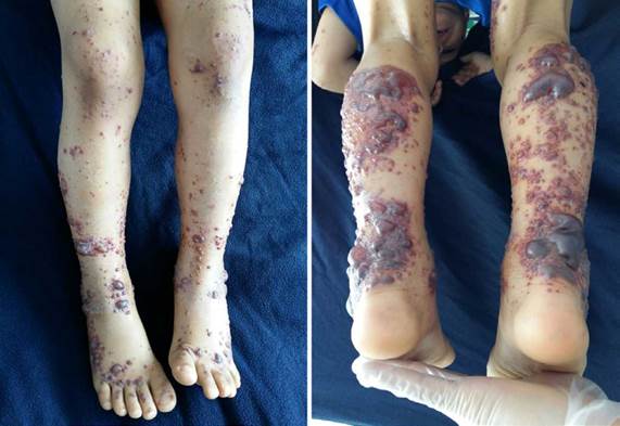 Purpuric lesions and phlyctenae on the lower limbs.