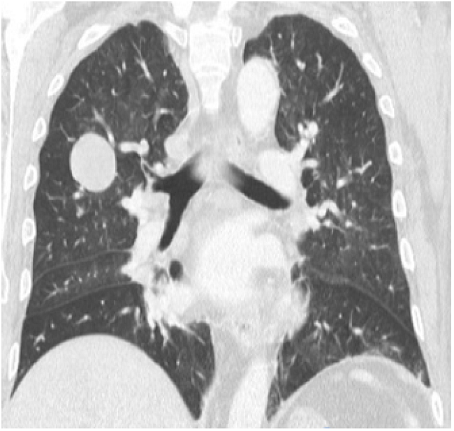 CT scan of the chest.