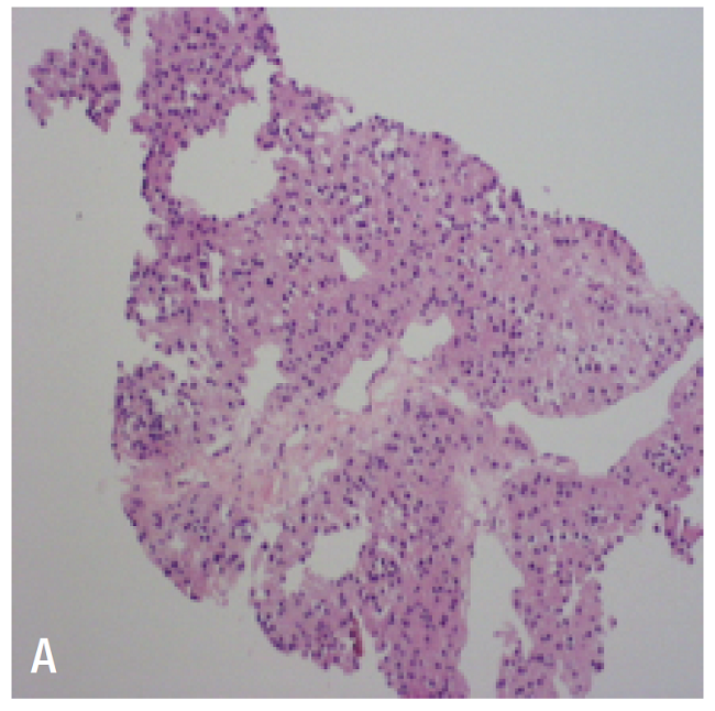 Liver lesion biopsy. A) adrenal gland with HE 40X staining; B) positive calretinin staining; C) melan-A.