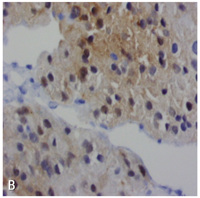 Liver lesion biopsy. A) adrenal gland with HE 40X staining; B) positive calretinin staining; C) melan-A.