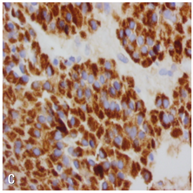 Liver lesion biopsy. A) adrenal gland with HE 40X staining; B) positive calretinin staining; C) melan-A.
