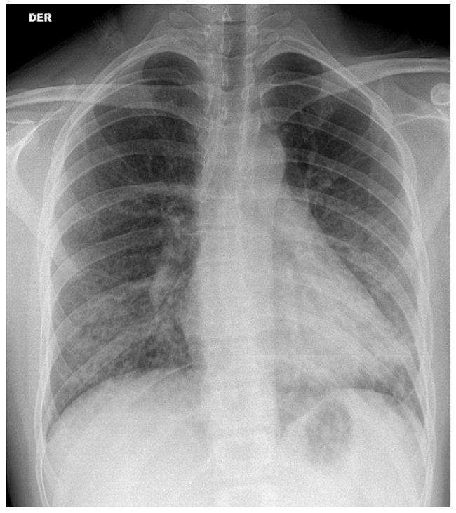 Radiograf&iacute;a de t&oacute;rax al ingreso que demuestra compromiso intersticial bilateral, de predominio perihiliar y basal mayor a izquierda y signos de vidrio esmerilado.
