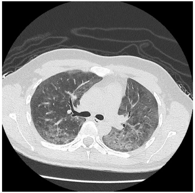 Tomograf&iacute;a axial computarizada de corte transversal de t&oacute;rax que evidencia patr&oacute;n de vidrio esmerilado y broncograma a&eacute;reo hacia las bases. 